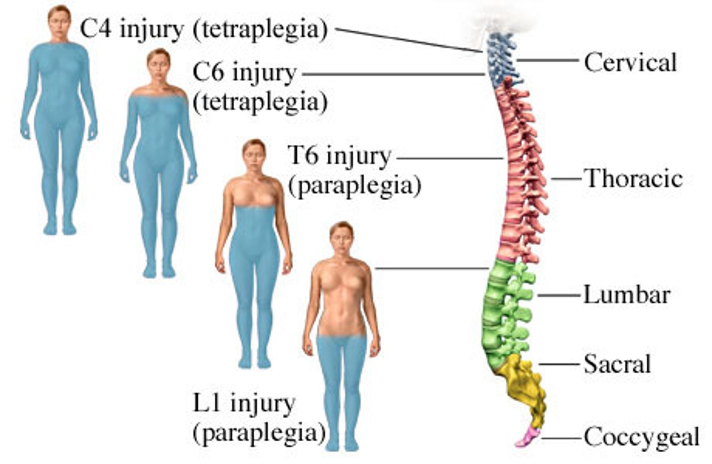 <p>the type of paralysis is determined by the level of the vertebra closest to the injury</p>