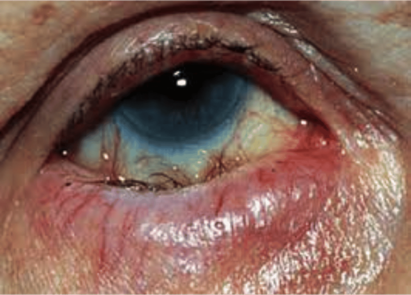 <p>Inverted Lower Lid</p>