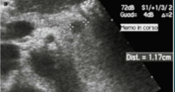 <p>Insulinoma</p>