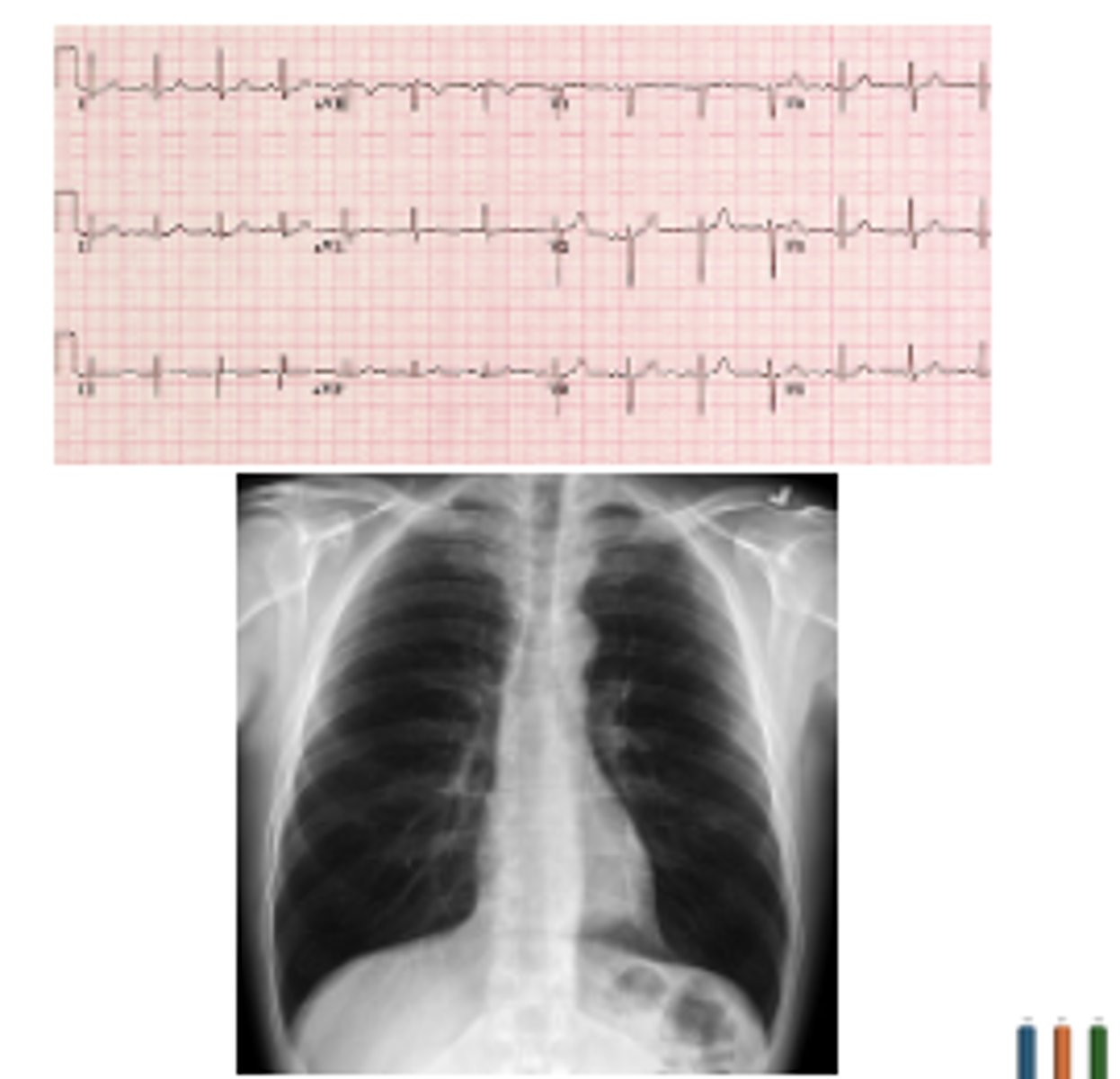 <p>A 93-year-old female with a past medical history of congestive heart failure (CHF) and GERD presents to the emergency department with chest pain. She states her symptoms began yesterday after a large meal. She describes the pain as a burning in her chest. She also notes some regurgitation and excessive belching. Physical exam reveals mild epigastric tenderness but is otherwise unremarkable. She denies shortness of breath, diaphoresis, or exertional chest pain. Vitals= Temp 37C, BP 120/80, HR 78, O2 95% on RA. ECG and chest xray are as below. High sensitivity troponin is normal. BNP is 117 pg/mL (Normal &lt;100 pg/mL). Which of the following is true?</p><p>A.The patient should receive diuresis to offload excess volume and relieve stress on her heart</p><p>B.The patient should be admitted for an acute MI</p><p>C.The patient should receive a GI cocktail</p><p>D.The patient is suffering from increased preload on her heart</p>