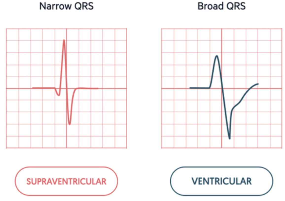 <p>An arrhythmia that <span style="color: purple;"><strong><mark data-color="purple" style="background-color: purple; color: inherit;">originates above the ventricles </mark></strong></span><span style="color: green;"><strong>(</strong></span><span style="color: green;"><strong>SA node, atria, or AV node)</strong></span></p>