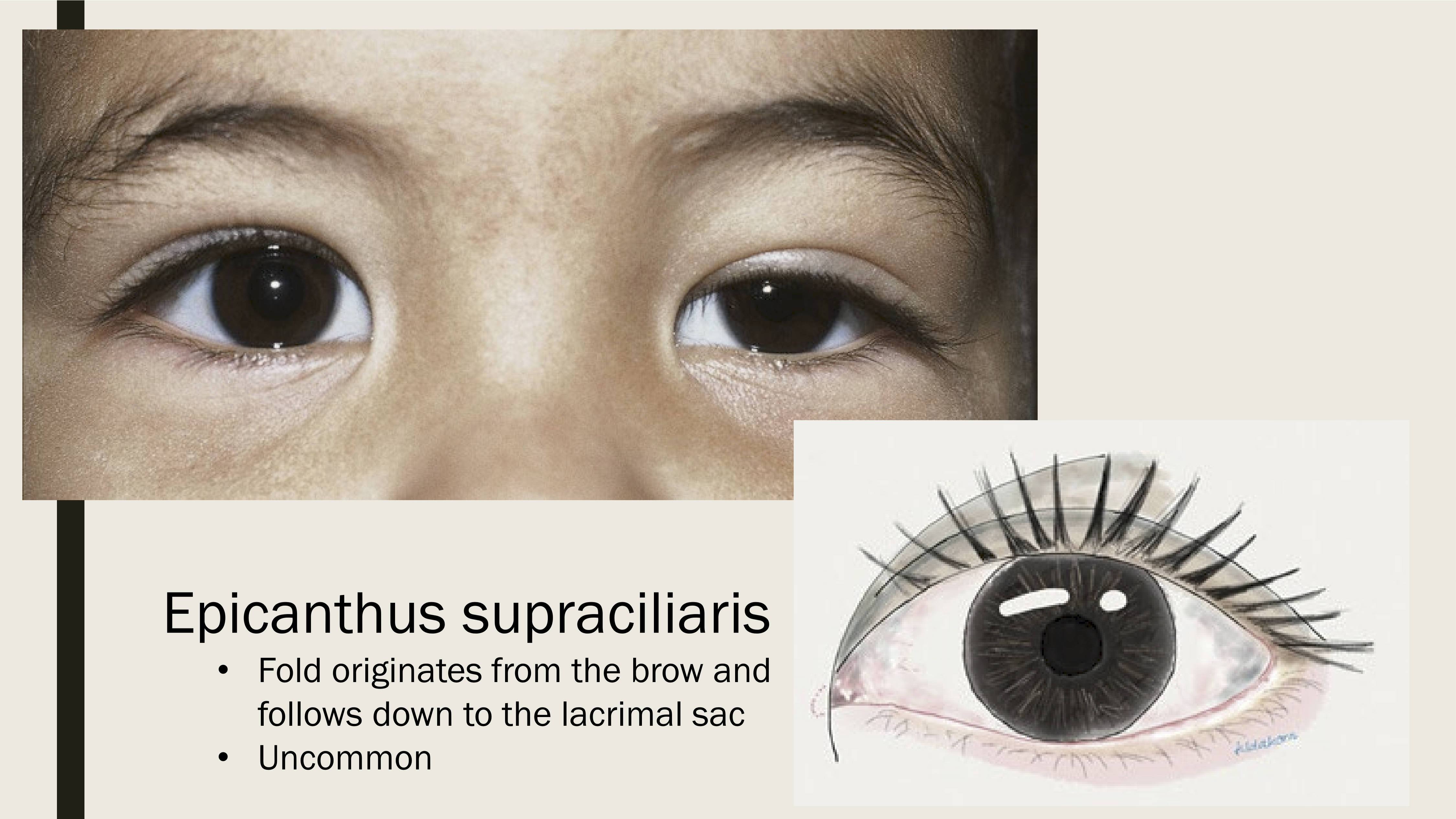<p>Skin fold originates from the brow and follows down to the lacrimal sack. It is the least common epicanthal fold variant. </p>