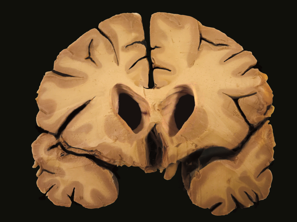 what type of brain does this MRI show