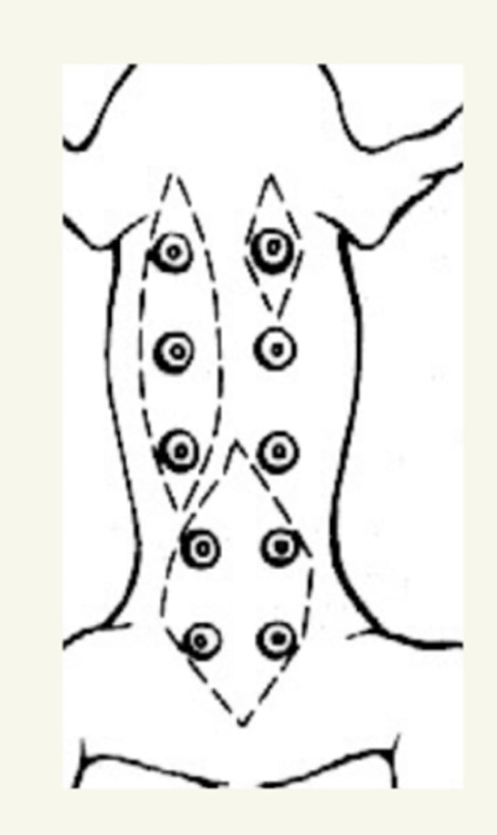 <p>la exéresis de la glándula mamaria afectada + las glándulas que comparten drenaje linfático junto con la extirpación de los ganglios linfáticos asociados</p>