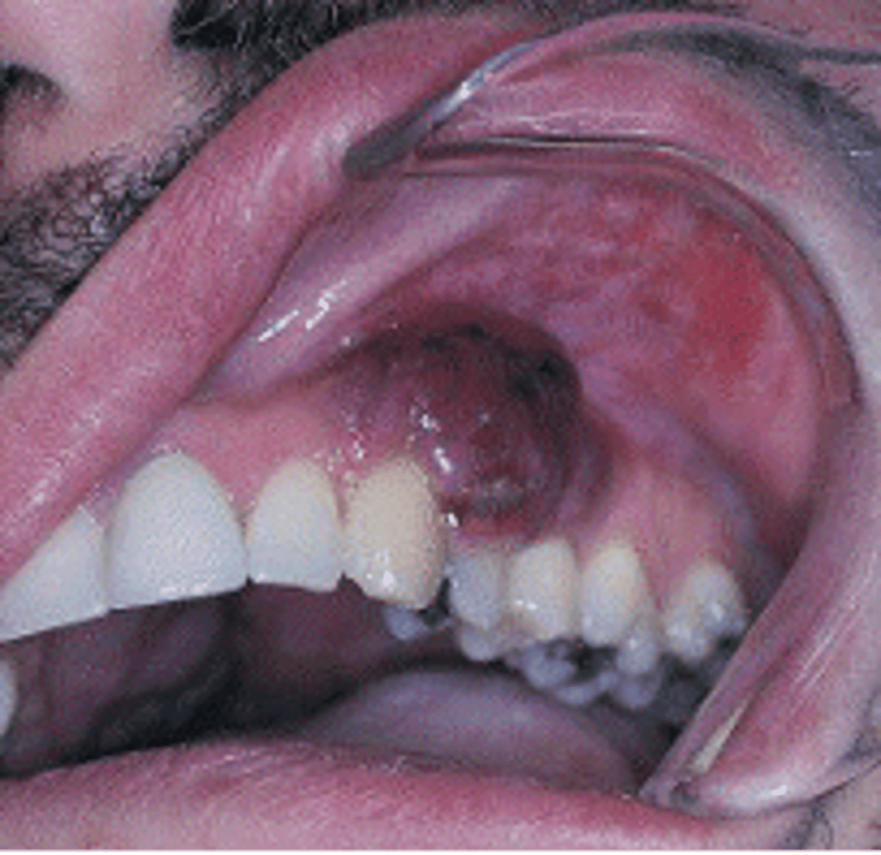 <p>Kaposi sarcoma (KS)</p>