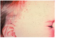 <p><span style="background-color: transparent; font-family: "Times New Roman", serif;">*Occurs <strong>before age 3</strong></span></p><p><span style="background-color: transparent; font-family: "Times New Roman", serif;">*<strong>Most acute</strong> form</span></p><p><span style="background-color: transparent; font-family: "Times New Roman", serif;">*<strong>Skin rash</strong>, enlarged spleen, liver, lymph nodes</span></p>