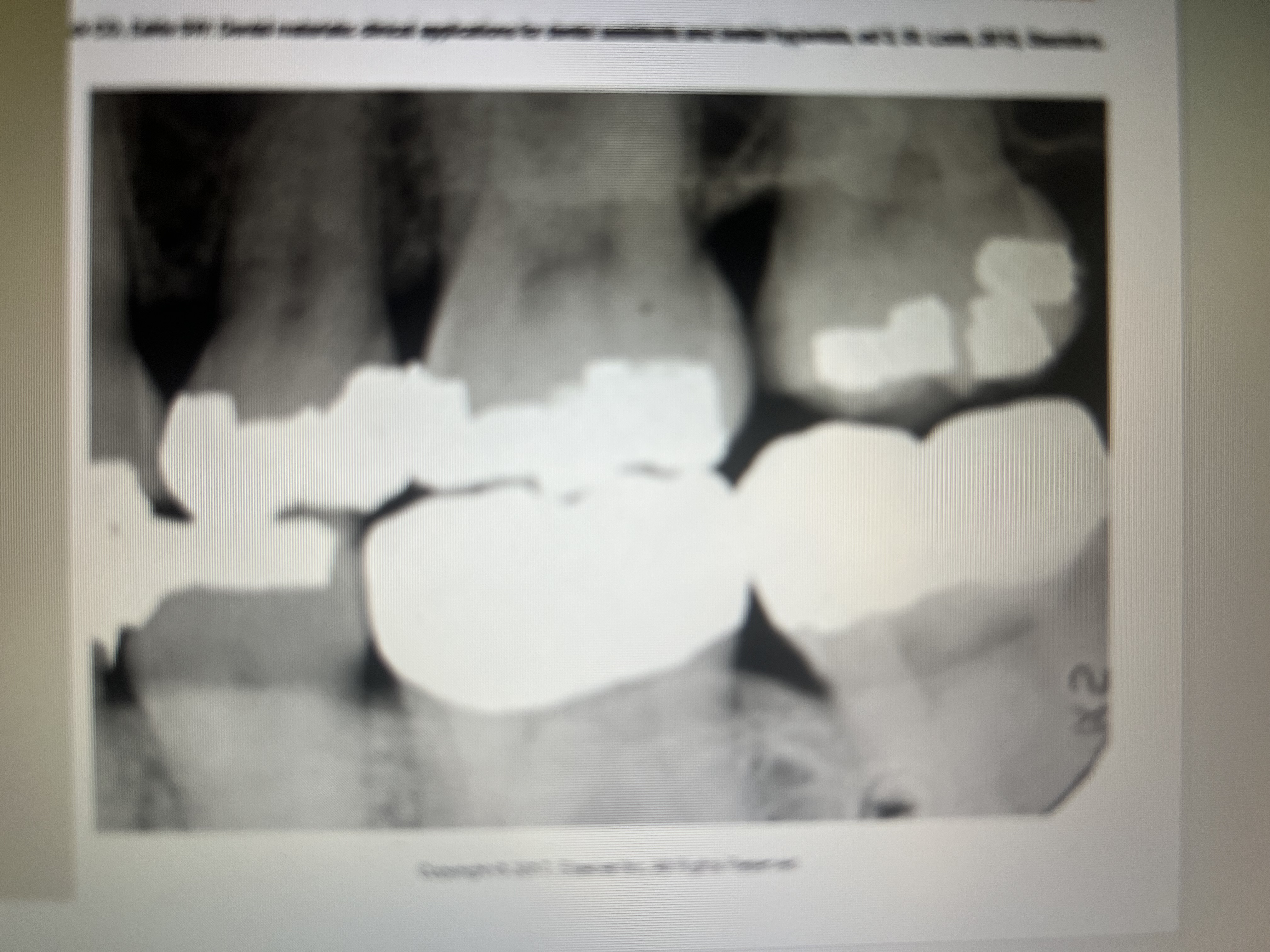 <p>Large radiopaque restorations with smooth contours and regular borders. #18 and 19. </p>