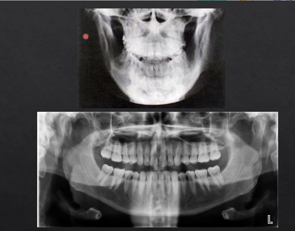 <p>PA radiographs vs panoramic radiographs DPT </p>