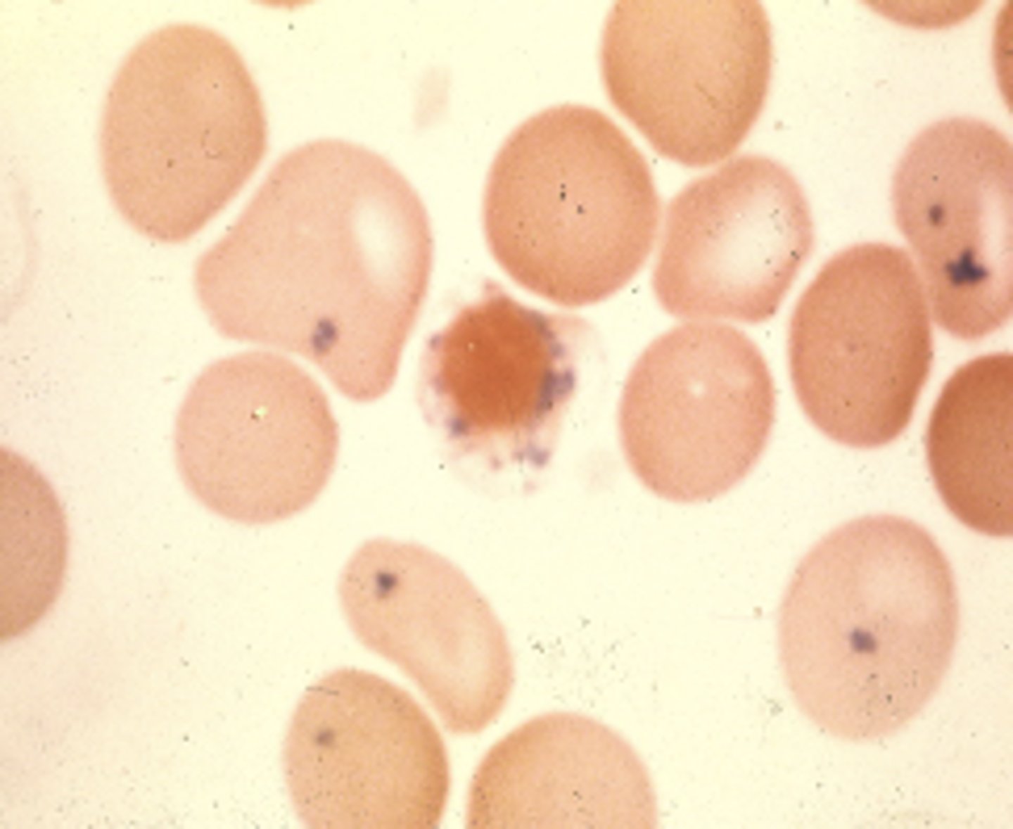 <p>- Single/multiple greenish-blue iron granules</p><p>-Prussian blue stained iron granules</p><p>- Etiology: Sideroblastic anemia</p><p>- From impaired Hgb synthesis</p>