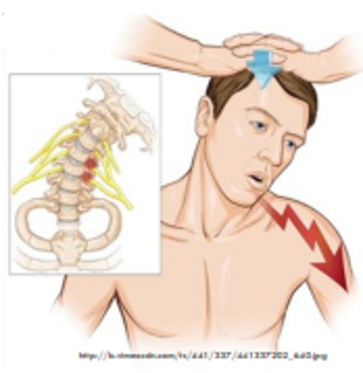 <p>spurling → axial load</p>