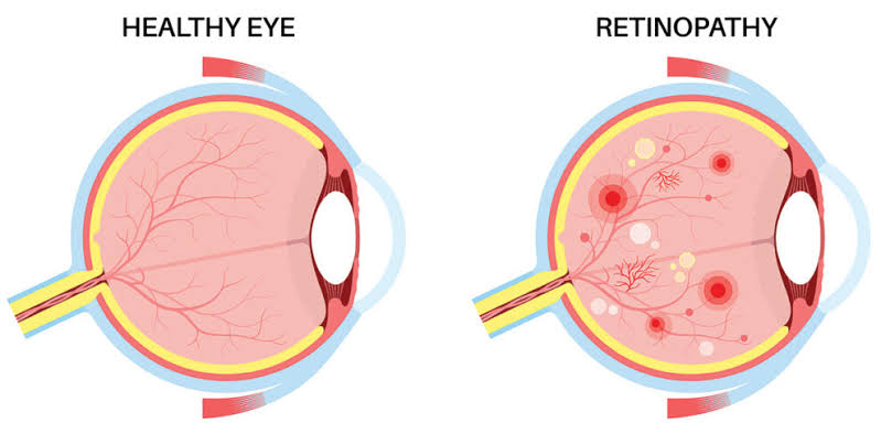 <p>Diabetic Retinothopy</p>