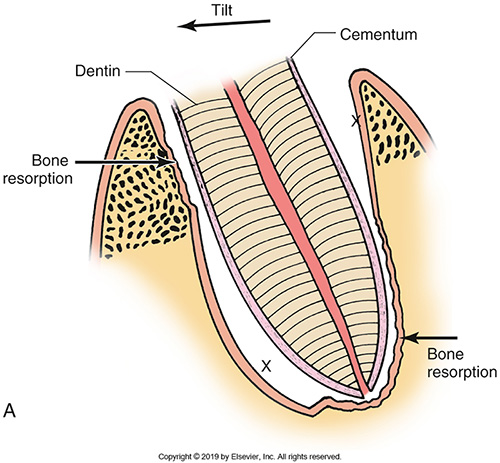 <p>Will occur due to the following:</p><ul><li><p>Trauma due to faulty occlusion</p></li><li><p>Periodontitis</p></li><li><p>Orthodontics</p></li><li><p>Mesial drift</p></li></ul><p></p>