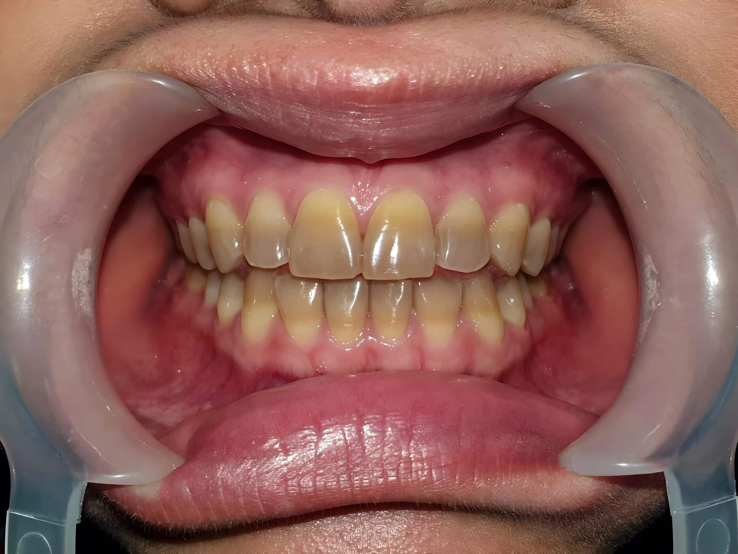 <ul><li><p>systemic tetracycline antibiotic therapy of the pregnant woman can act as a teratogenic drug during fetal period</p></li><li><p>intrinsic yellow to yellow-brown discoloration within teeth can occur in slight, moderate, or severe degrees as antibiotic becomes chemically bound to tooth</p></li><li><p>easily visible</p></li><li><p>permanent teeth may be effected</p></li><li><p>may require full cover crowns or veneers to improve appearance or even whitening </p></li></ul><p></p>