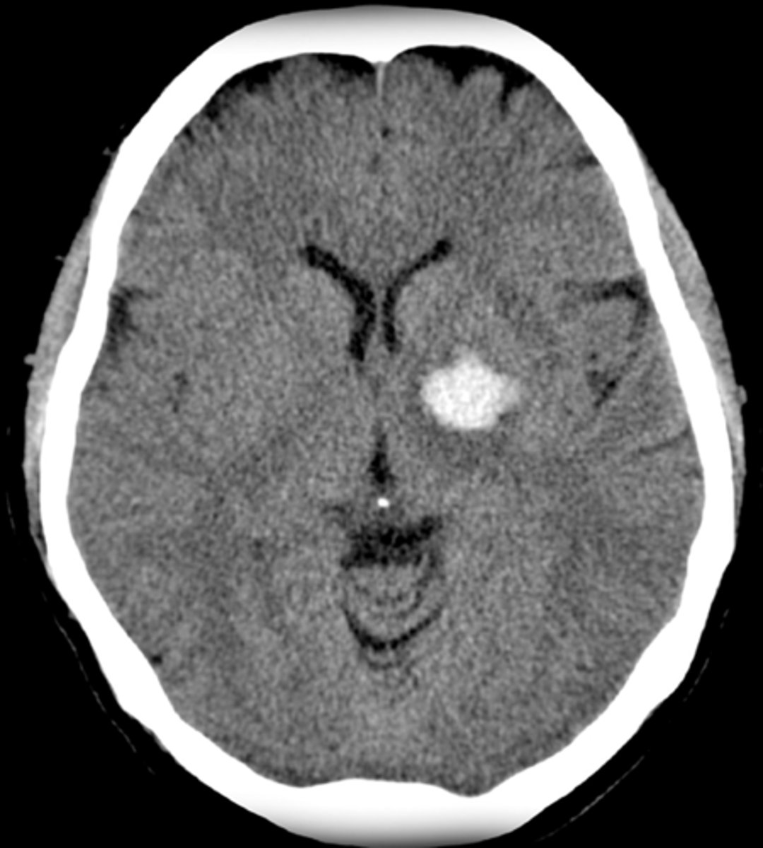 <p>white blot in the middle of the brain</p>