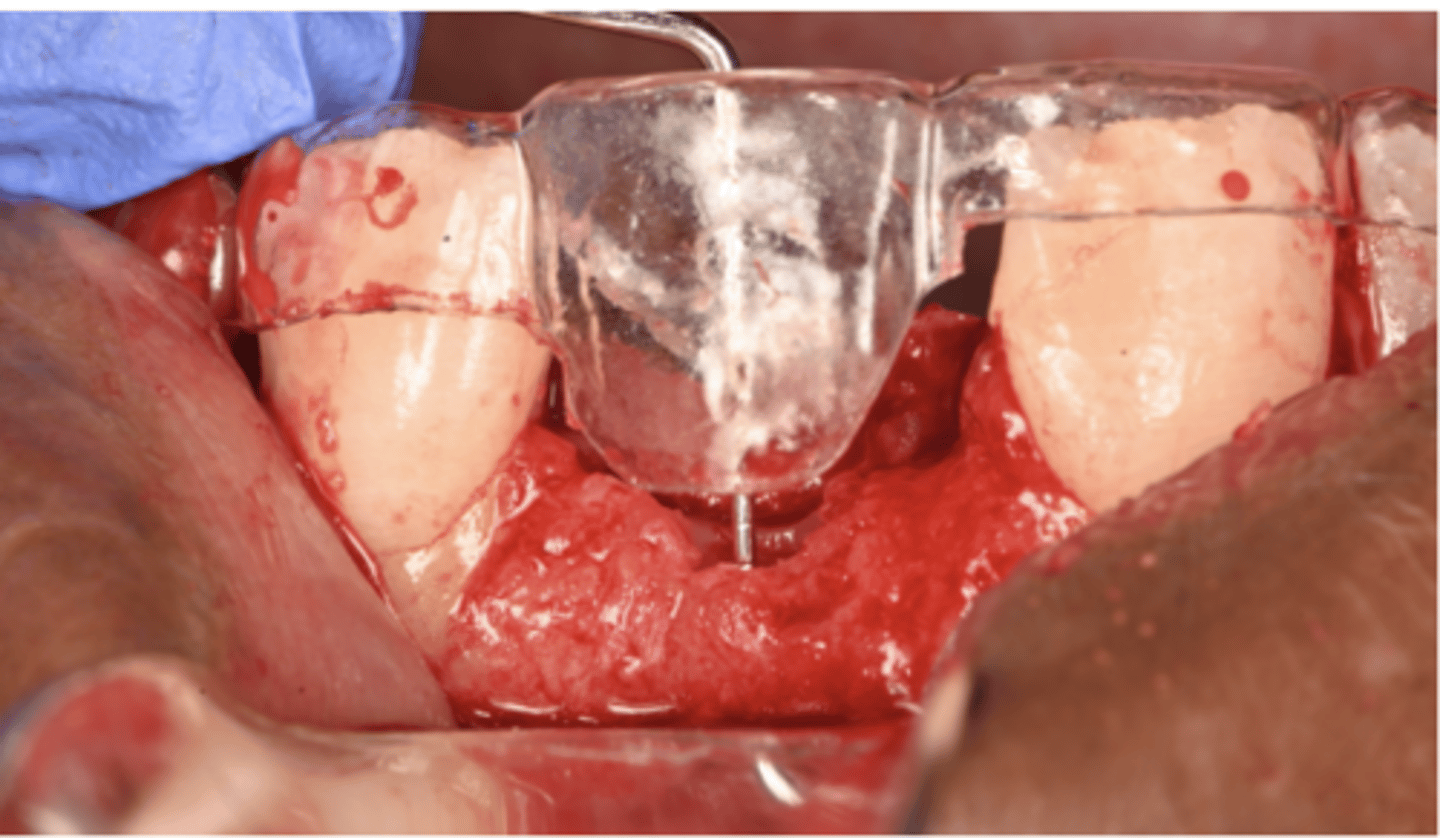 <p>The picture below is showing ideal 3D implant position, please select correct sentence. (select one)</p><p>A. Bone level implant should be placed 1-2 mm deep from future (ideal) cervical line of the restoration</p><p>B. Tissue level implant should be placed 3-4mm deep from ideal (future) cervical line of the restoration.</p><p>C. Bone level implant should be placed 3-4 mm deep from future (ideal) cervical line of the restoration</p><p>D. Bone level implant should be placed 2 mm deep from future (ideal) cervical line of the restoration</p>