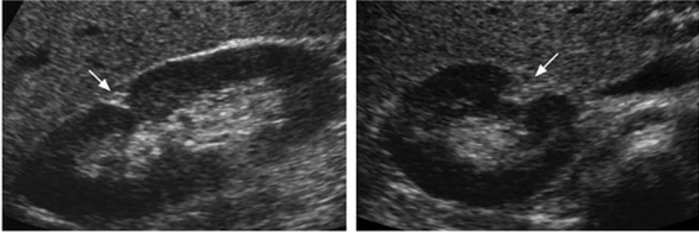 <p>What normal variant of the kidney is an echogenic, triangular indention in the upper pole of the renal parenchyma, which is a result of partial fusion of the two embryonic ranunculi that form the kidney?</p>