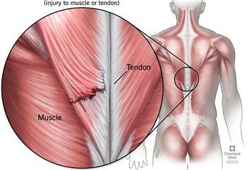 muscle tear (10 days-2 weeks to heal, rich circulation)
