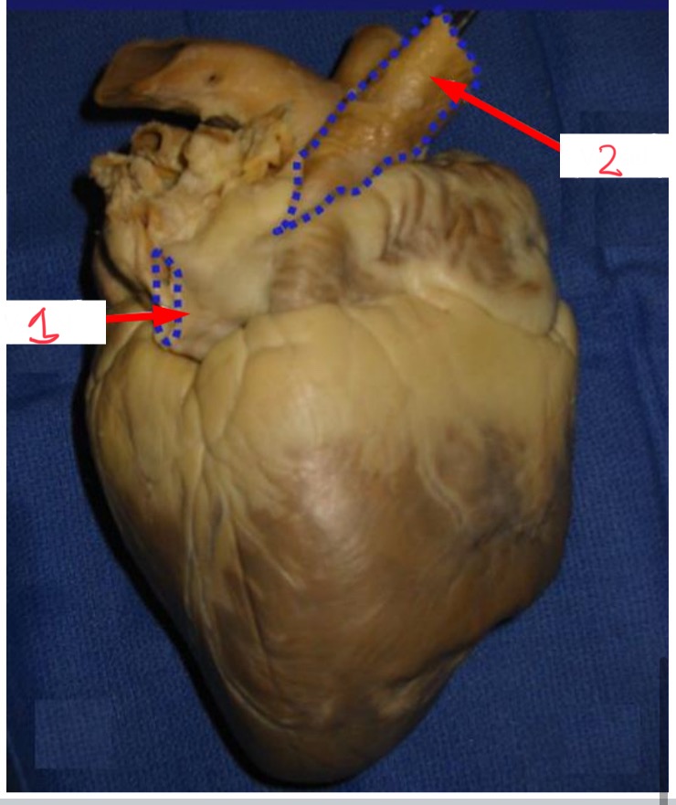 <p>What vessel is 2 pointing to?</p>