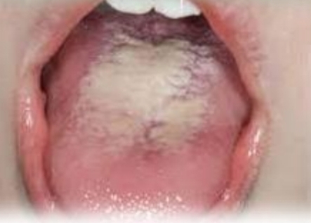 <p>White or yellow nonadherent coating on dorsal tongue, potential halitosis</p><p class="has-focus">Asymptomatic</p><p class="has-focus">First and second decades</p><p class="has-focus">No gender bias</p>