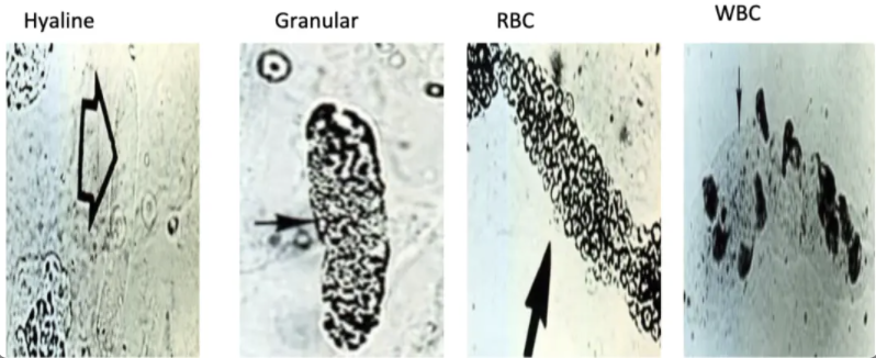 * hardened cell fragments, usually cylindrical found in the urine
* Almost always pathologic
* due to pathological problems such as nephritis, \\n dehydration
* Can only observe casts by doing a sediment study