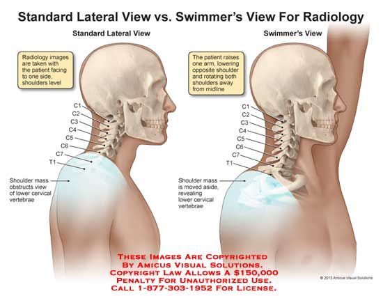 * position the arm farthest from the IR down along the patient’s side with the shoulder depressed 


* the arm closest to the IR should be elevated with the elbow flexed and the forearm resting on the patient’s head 

(if supine, rest head on arm closest to the IR so that it is still out of the way) 