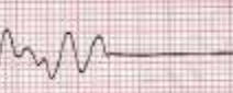 <p>Which cardiac rhythm is shown?</p>