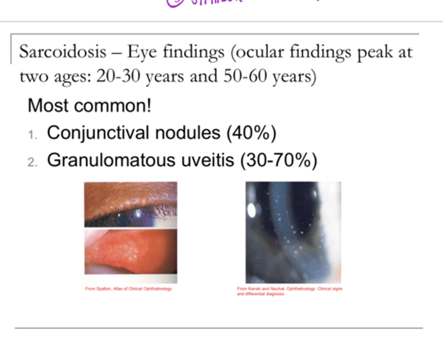 <p>REVIEW: What are the most common eye findings of sarcoidosis?</p>