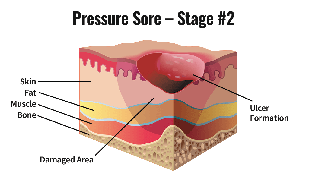 <p>Stage 2 Pressure Injury </p>