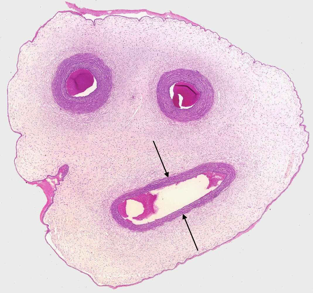 <p>3. The image shows a cross-section of the umbilical cord.</p><p>In which of the following structures in an adult human can a remnant of the structure marked by arrows be found?</p><p>A. Ligamentum teres hepatis (Round ligament of the liver)</p><p>B. Ligamentum teres uteri (Round ligament of the uterus)</p><p>C. Plica umbilicalis lateralis (Lateral umbilical fold)</p><p>D. Plica umbilicalis medialis (Medial umbilical fold)</p><p>E. Plica umbilicalis mediana (Median umbilical fold)</p>