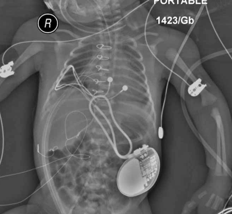<ul><li><p class="">Interventional catheterization</p></li><li><p class="">Cardiac surgery</p></li><li><p class="">Pacemakers</p></li><li><p class="">Cardiac transplantation</p></li><li><p class=""><strong>Medical Management Interventions</strong>:</p><ul><li><p class="">Pharmaceutical</p></li><li><p class="">Dietary</p></li><li><p class="">Activity</p></li></ul></li><li><p class="">Supportive care/community care</p></li></ul><p></p>