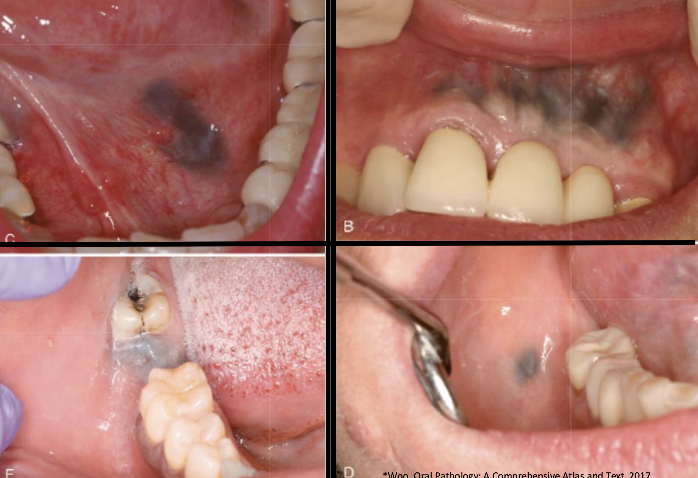 <p>which pigmented lesion </p>