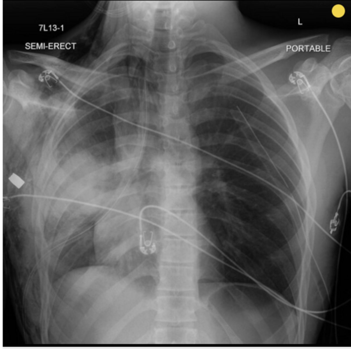 <p>Name the condition (pt has hx of trauma to chest)</p>