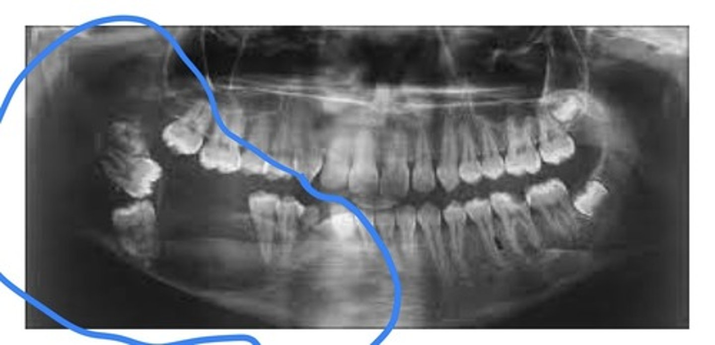<p>This is a type of mixed odontogenic tumour. A benign, nonencapsulated odontogenic tumour. Occurs in young children and young adults, more often in males. Most commonly in the mand bicuspid and molar region.</p>