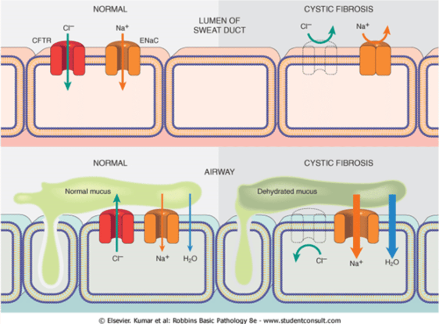 <p>Sweat glands: Na + Cl secreted but no reabsorption of Cl- due to CFTR mutation, salty sweat.</p><p>Resp/pancreatic epithelium: less active transport of Cl- due to CFTR mutation and more Na into cell. Water follows &gt; dehydrated mucus. </p>