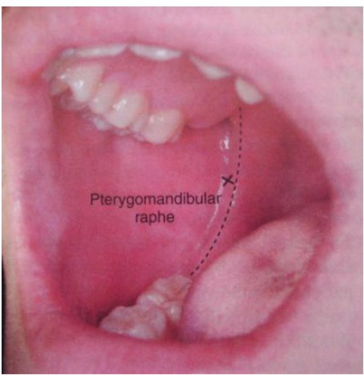 <p>What is the pterygomandibular fold important for?</p>