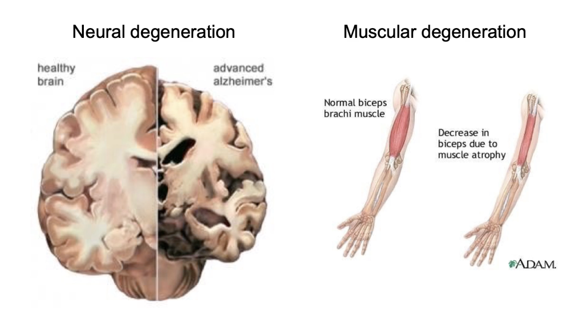 <p><strong>Excessive apoptosis leads to disease</strong></p><ul><li><p>Alzheimer’s: hippocampus neuron death and certain parts of cerebral cortex</p></li><li><p>Huntington’s: striatum neuron death</p></li><li><p>Parkinson’s: dopamine neuron loss in substantia nigra</p></li><li><p>Duchenne muscular dystrophy: muscle degeneration from cell death</p></li></ul><p></p>