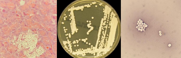 <p><span style="font-family: &quot;Times New Roman&quot;, serif; line-height: 107%;"><span>Clinical association: cats (pneumonia, CNS, nasal masses); most common systemic fungal pathogen in cats</span></span></p><p class="MsoListParagraphCxSpMiddle"><span style="font-family: &quot;Times New Roman&quot;, serif; line-height: 107%;"><span>Histology: soap bubble appearance due to the capsule</span></span></p><p class="MsoListParagraphCxSpMiddle"><span style="font-family: &quot;Times New Roman&quot;, serif; line-height: 107%;"><span>India ink: shows thick capsule</span></span></p><p class="MsoListParagraphCxSpLast"><span style="font-family: &quot;Times New Roman&quot;, serif; line-height: 107%;"><span>Culture: small, mucoid colonies</span></span></p><p class="MsoListParagraphCxSpLast"><span style="font-family: &quot;Times New Roman&quot;, serif; line-height: 107%;"><span>What is it?</span></span></p>