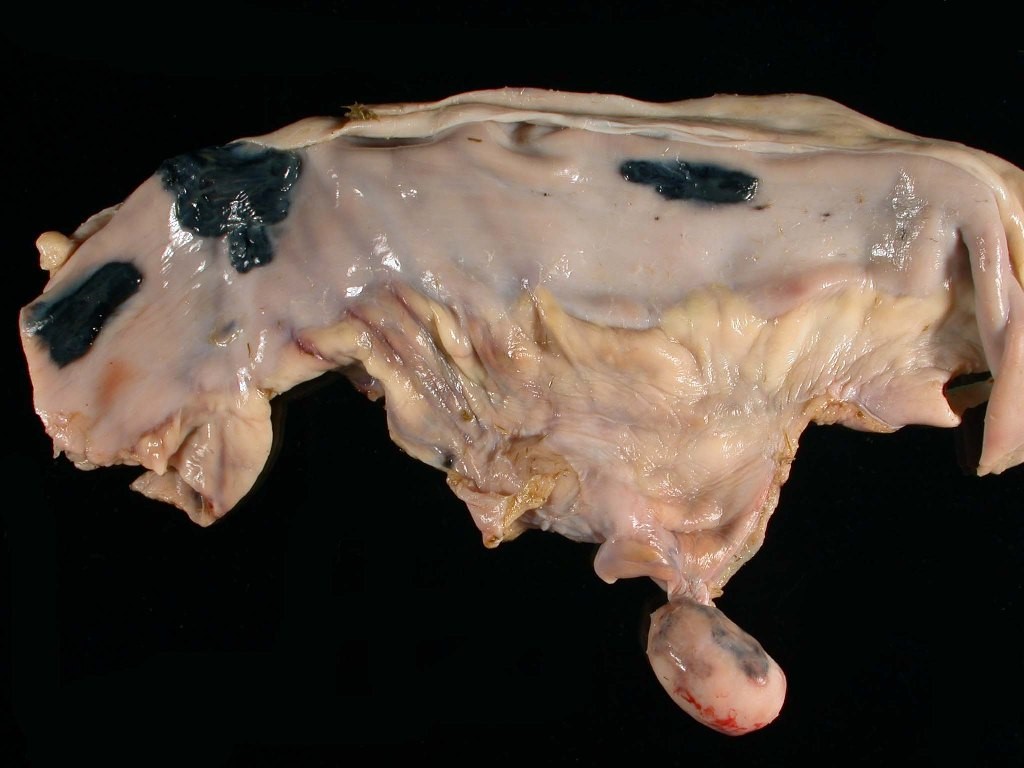 <p><span><span>This is small intestine from a horse that shows multifocal black foci representative of a condition referred to as hemomelasma ilei as well as a mesenteric, pedunculated lipoma that was NOT wrapped around the intestine. These lesions both are best defined as:</span></span></p><p>Incidental lesions</p><p></p><p>Clinically significant lesions</p><p>&nbsp;</p><p>Agonal lesions</p>