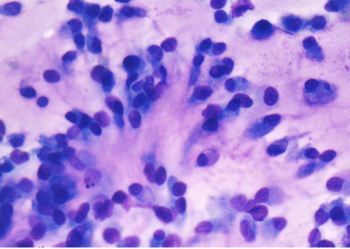 <p>You take a cytology sample from the brachial plexus area from a dog exhibiting signs of pain, lameness to muscle atrophy, and paresis.</p><p>The sample appears to have palisading spindle cells</p><p>What is your top differential?</p>