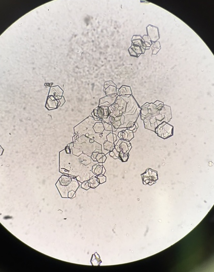 <p>The crystals seen in these images are:</p><p></p><p>Leucine crystals</p><p>Bilirubin crystals</p><p>Cystine crystals</p><p>Cholesterol crystals</p>