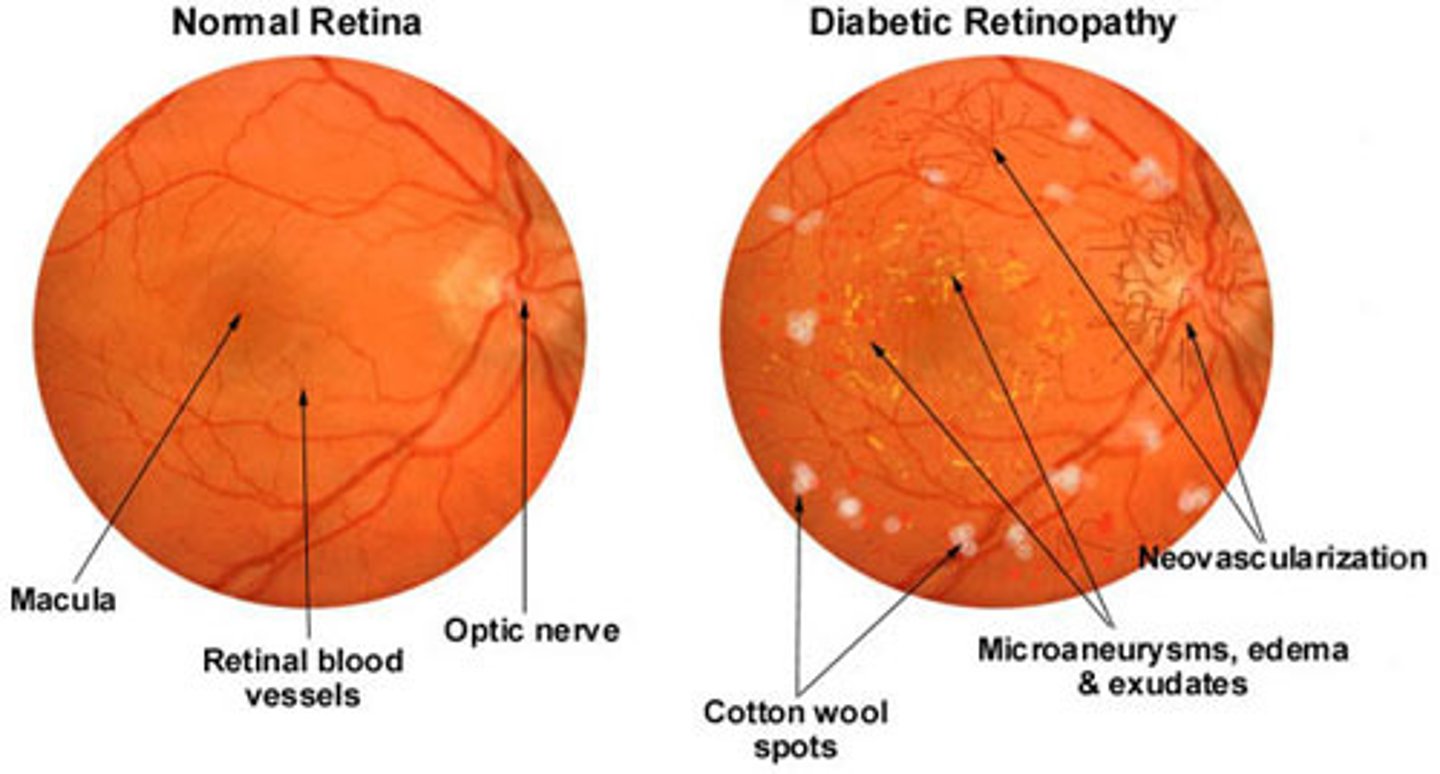 <p>Diabetic cataracts; glaucoma; diabetic retinopathy (proliferative vs. non-proliferative); annual ophthalmologist visits</p>