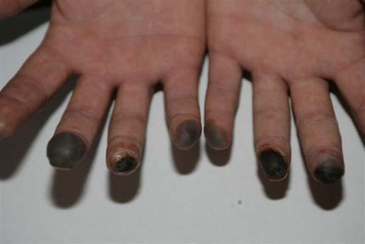 <p>condition in which the body tissues become frozen, circulation ceases when ice forms within the tissues</p>