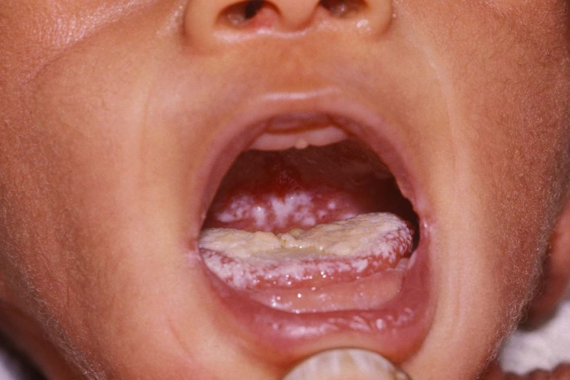 <p>risk of oral candidiasis or oral thrush (a fungal infection)</p>