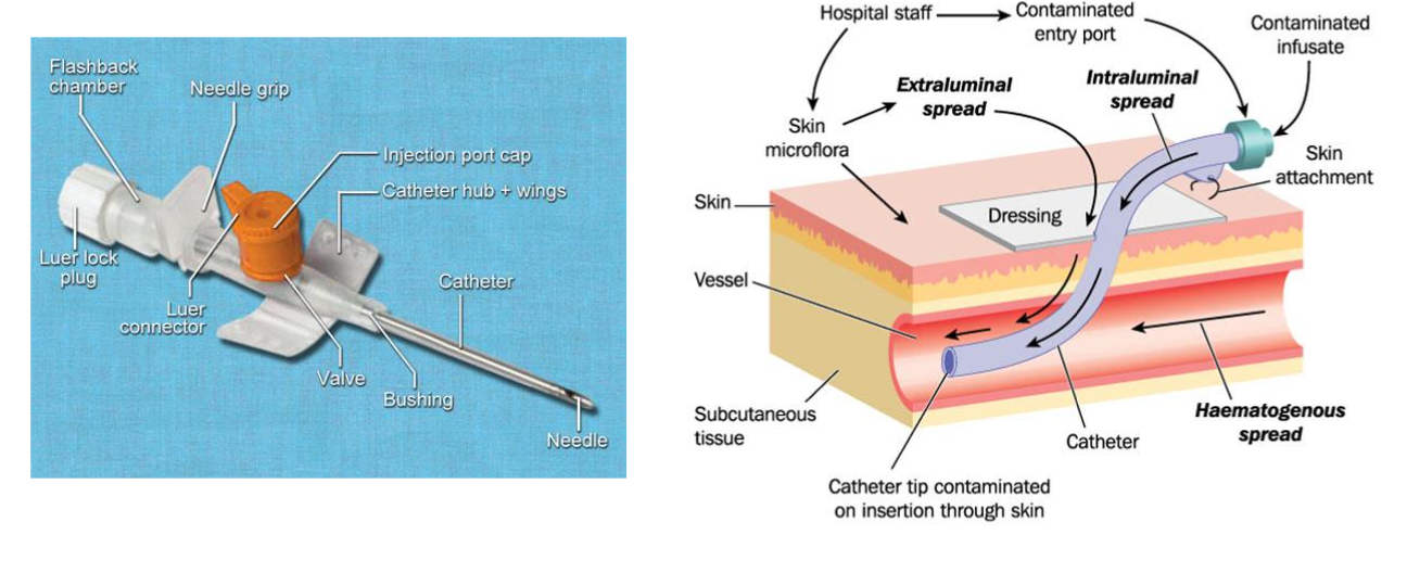 <p>• Hold cannula and rotate the barrel 360 degrees</p><p class="p1">• Apply skin traction to immobilize the vein</p><p class="p1">• Ensure cannula has bevel side UP and insert at approximately 30 degree angle</p><p class="p1">• You will see a flashback of blood in the chamber once you have pierced the vein</p><p class="p1">• Then advance the cannula a few more millimetres and then flatten the cannula, stabilise</p><p class="p1">the device and advance the cannula until at skin level</p><p class="p1">• Remove the stylet and apply pressure just beyond the catheter tip</p><p class="p1">• Gently stabilise the cannula hub</p><p class="p1">• Release the tourniquet</p><p class="p1">• Attach the extension line</p><p class="p1">• Apply dressing and secure cannula</p><p class="p1">• Flush cannula with 5-10ml 0.9% sodium chloride to ensure patency</p><p class="p1">• Connect to IV fluid</p><p class="p1">• Dispose of sharps and waste</p><p class="p1">• Document in patient notes</p>