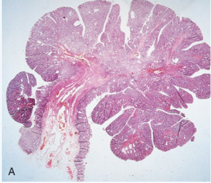 A 53-year-old woman undergoes a routine checkup. The only abnormal finding is a stool specimen that contains occult blood. Colonoscopy shows a 1.5 cm, solitary, rounded, erythematous polyp on a 0.5 cm stalk at the splenic flexure. The polyp is removed; its histologic appearance is shown in the figure at low (A) and high (B) magnifications. Her colonic lesion is most likely associated with which of the following?