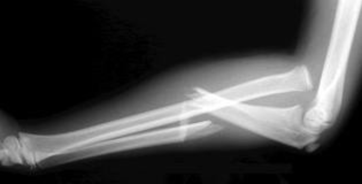 <p>- dislocation of proximal radioulnar joint</p><p>- ulnar fracture</p>
