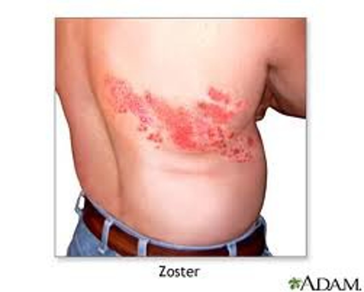 <p>a reactivation of the chickenpox virus in the body, causing a painful rash. The spinal cord is affected</p>