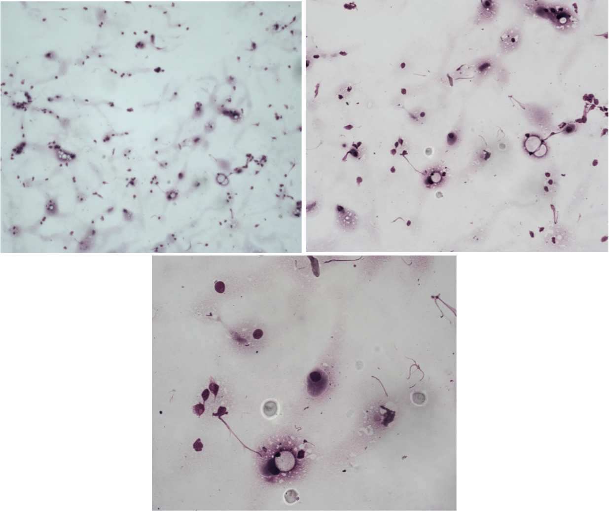 <p>Utstryk 4<br>Parabasalceller: <br>Intermediärceller: <br>Superficialceller: <br>Erytrocyter: <br>Neutrofiler:</p><p>Stadium:</p>