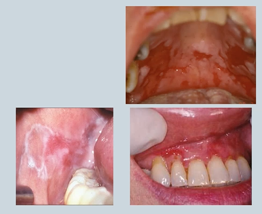 <ul><li><p>Pemphigus </p></li><li><p>Pemphigoid </p></li><li><p>Lichen Planus - can be in other areas of the body </p></li></ul><p></p>
