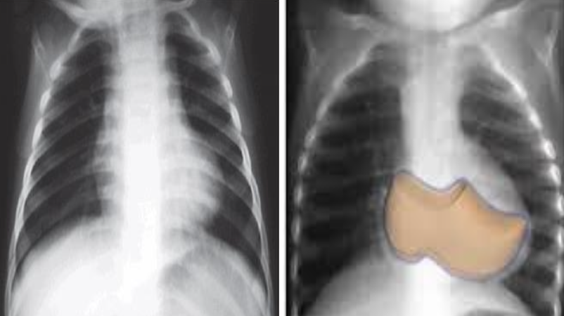<p>A - Aorta cabalgante<br>E - Estenosis pulmonar<br>I - Hipertrofia V der<br>O - Comunicación interventricular</p><p>Imagen: Radiografía muestra arco medio izq excavado, punta levantada y pulmonar algo disminuido.</p>